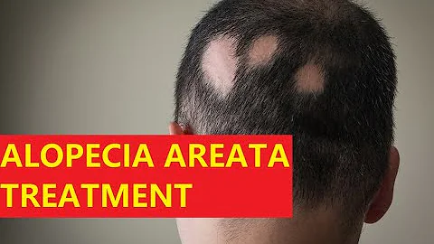 《生活分享》#1 頭髮掉的都快禿了？四個步驟 看我如何挽救脫髮/斑禿/鬼剃頭,分享治療方法 生物素 生薑洗髮水 密發水 脫髮藥膏 Alopecia Areata Hair Loss Treatment - 天天要聞