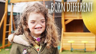 The Girl Born Without A Nose | BORN DIFFERENT