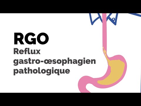 Reflux gastro-œsophagien (RGO) pathologique | Société gastro-intestinale