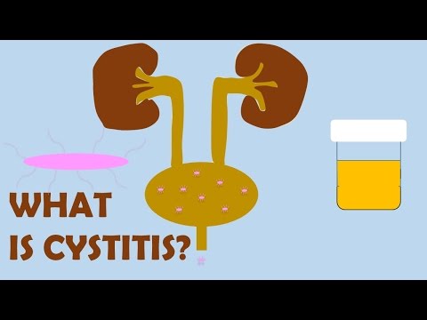 Video: Postkoitalinis Cistitas - Postkoitalinio Cistito Priežastys, Simptomai Ir Gydymas