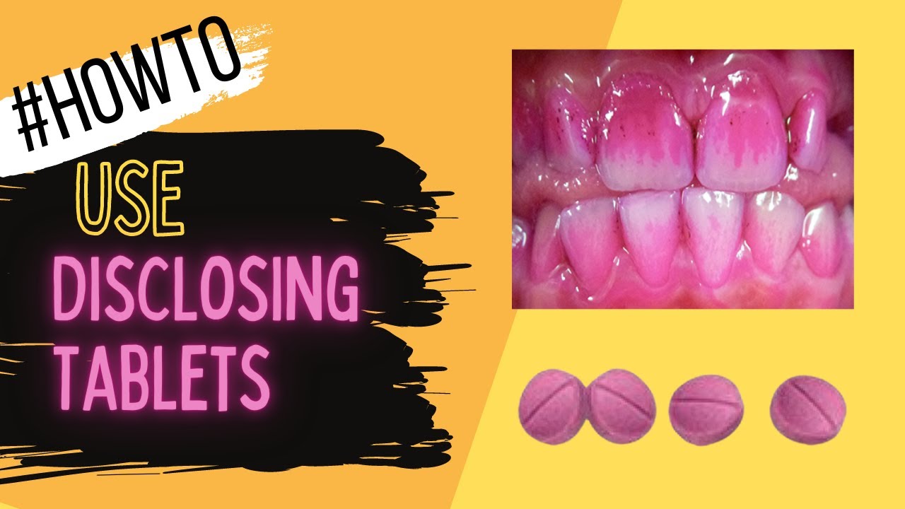 How Use Plaque Disclosing Tablets Show Dirty Teeth - Dentaly.org