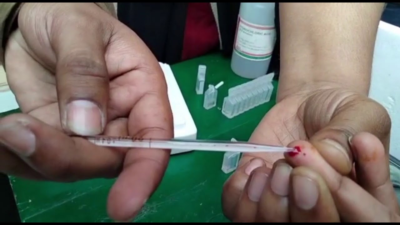 HAEMOGLOBIN TEST BY:- SAHLI’S HEMOGLOBINOMETER - YouTube