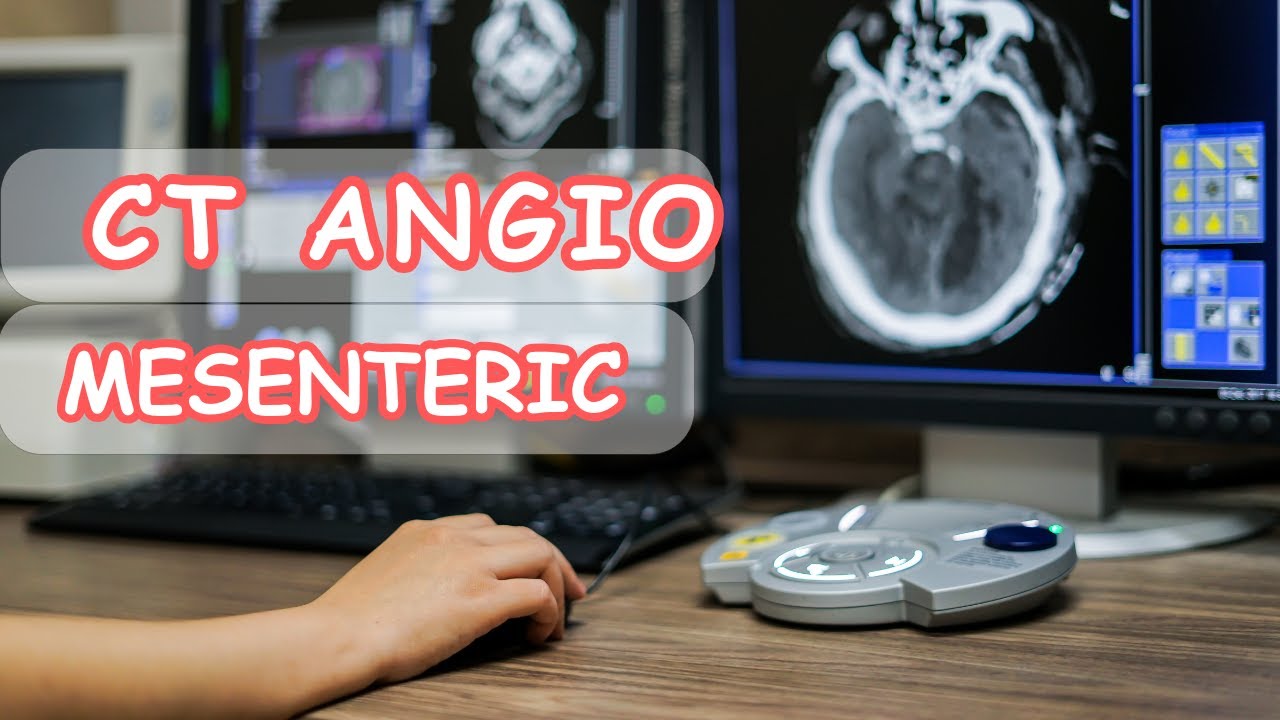 Ct angio mesenteric التصوير المقطعى لشرايين الأمعاء