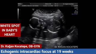 Echogenic intracardiac focus on fetal ultrasound. Is it a heart disease? When will it go away? screenshot 4