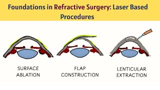Understanding Refractive Surgery #:2  Surface, Flap & Lenticule Techniques Explained