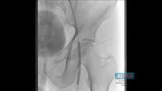 Retrograde Access to Popliteal and CFA