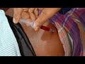 b12 injection in buttocks video Buttock . Vitamin b1,b6,b12 