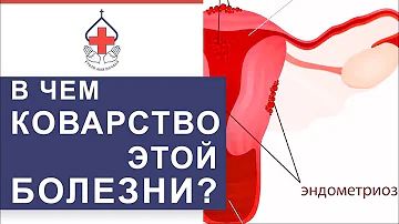 👩 Чем опасен генитальный эндометриоз и как его лечат. Чем опасен эндометриоз. 12+
