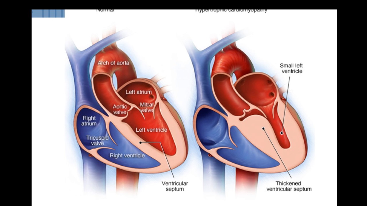 Кардиомегалия Как лечить кардиомегалию - YouTube
