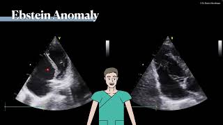 〖Echocardiography〗 Ebstein anomaly 💘