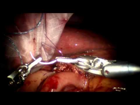 Robotic Pancreaticoduodenectomy from KMUH