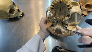 Base do Crânio: Forames, Canais e demais Acidentes Ósseos (Vista inferior)