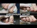 Утолщение ногтей и онихолизис из-за деформации пальцев ног. Зачистка онихолизиса и педикюр пальцев