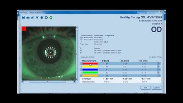 Tip Instructional – Eyesuite Biometry: White to White measurement
