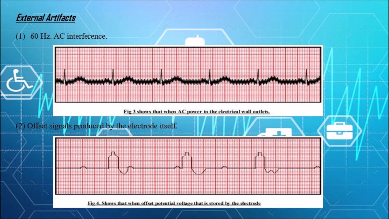 Movement Artifacts During Biosignal Acquisition YouTube Movement Artifacts During Biosignal Acquisition YouTube