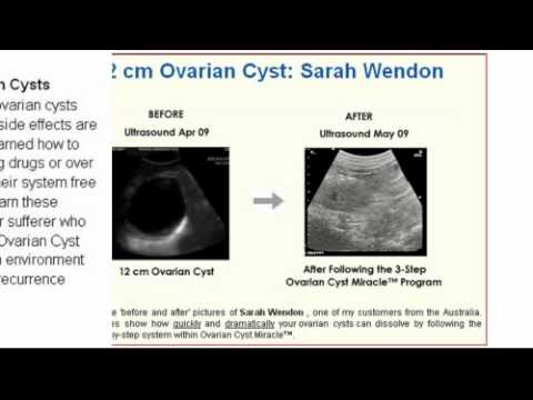 Home Remedies To Remove Ovarian Cyst Home Remedies To Remove Ovarian Cyst
