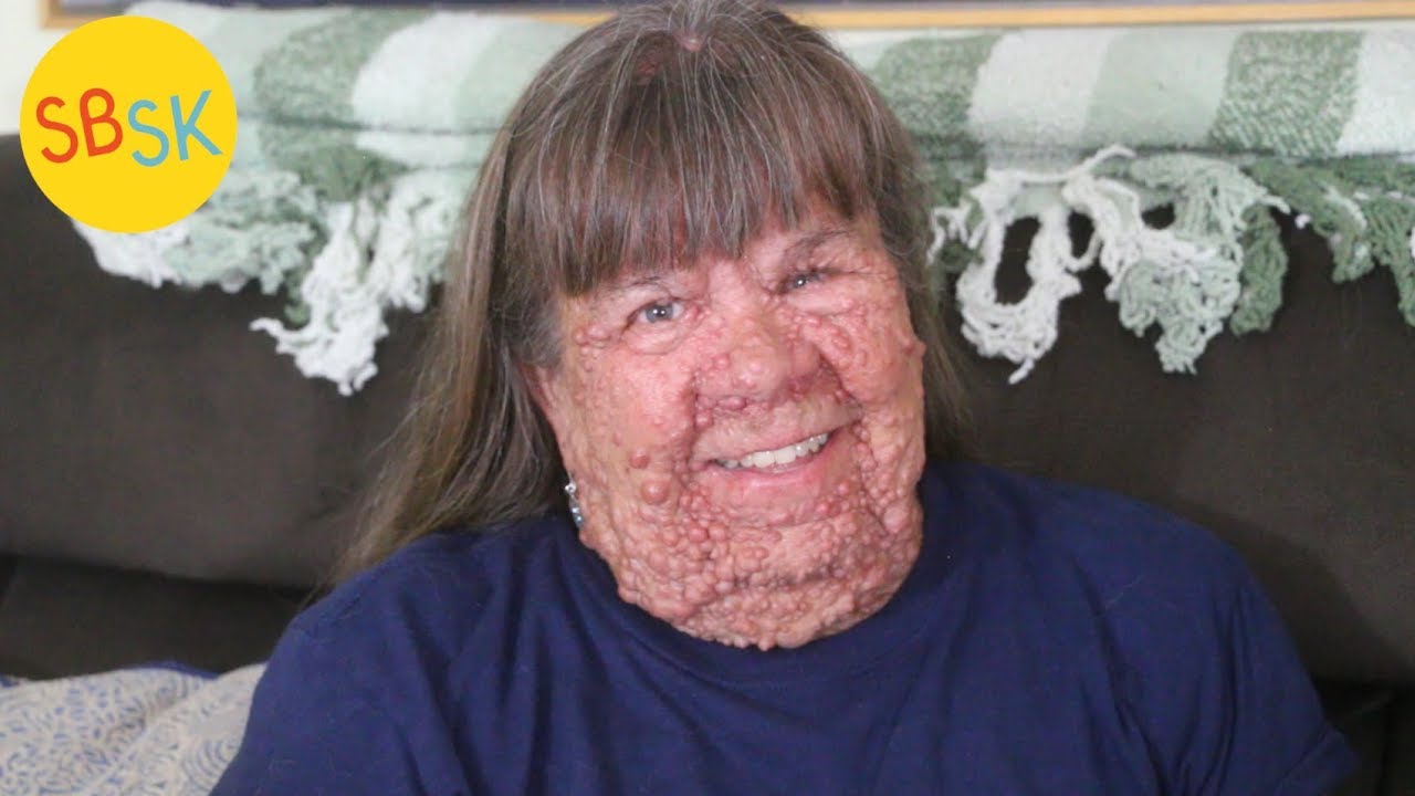 Living With 1000s Of Tumors And Marrying A Man With The Same Condition living-with-1000s-of-tumors-and-marrying-a-man-with-the-same-condition