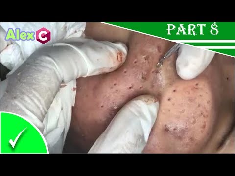 how to removal Blackheads and Pimple popping| Cystic acne extractor