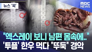 [뉴스 ‘꾹’] "엑스레이 보니 남편 몸속에.."  '투플' 한우 먹다 "뚜둑" 경악 (2024.05.15/MBC뉴스)''