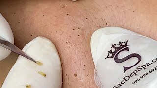 Blackhead On The Skin Of Young Girl | Làm Sạch Mụn Đầu Đen Trên Da Cô Gái Trẻ - SacDepSpa#250