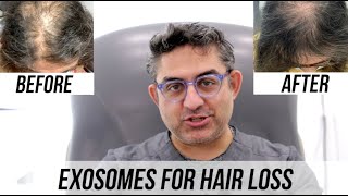 Exosomes for Hair Regrowth