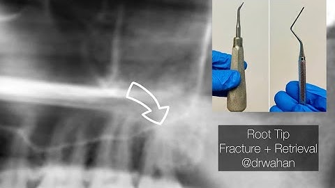 Root Tip Fracture + Retrieval with Cogswell Elevator and Root Tip Pick on an Erupted Wisdom Tooth.