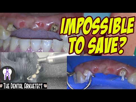 Video: Paano Ayusin ang isang Nawala na Crown Dental: 15 Hakbang (na may Mga Larawan)