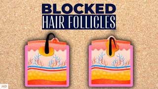 Blocked Hair Follicle – Everything You Need To Know