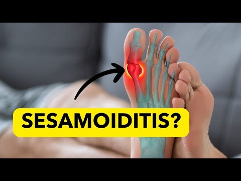 Sesamoiditis-Home Remedies- What is It? (Pain at the base  of Big Toe)