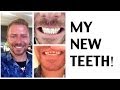 THIS IS WHAT VENEERS LOOK LIKE - IN REAL LIFE!