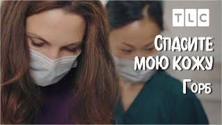 Горб | Спасите Мою Кожу | Tlc