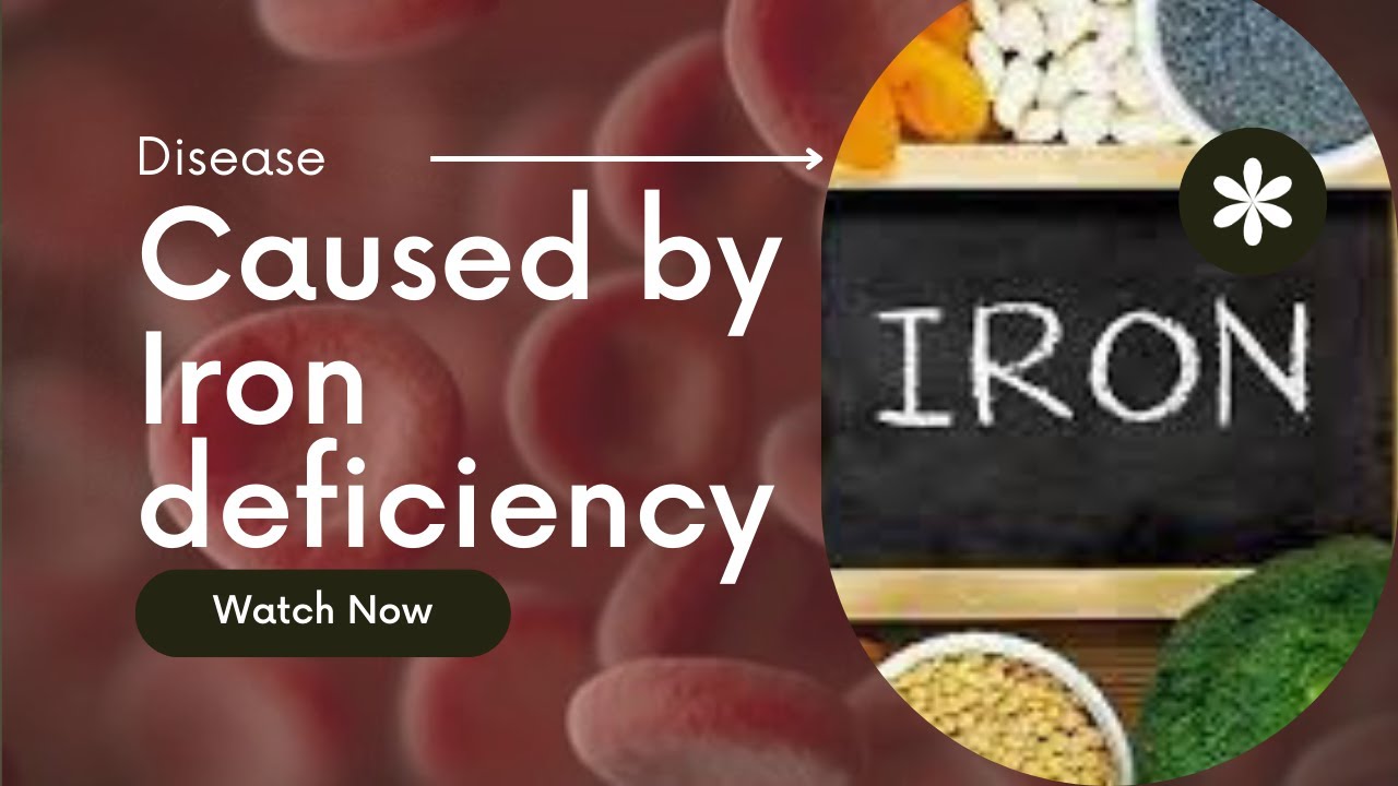 IRON DEFICIENCY SYMPTOMS Top 10 Deficiency Symptom of Iron in Human