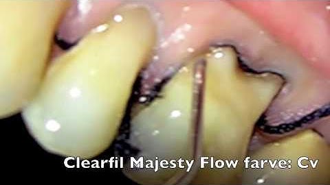 Clearfil Majesty Flow Class V fillings restoring tooth no. 24, no. 25 & no. 26 by Dr. HAJJ