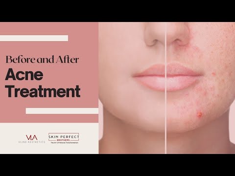 Acne Scars Removal - Before and After | Skin Perfect Medical Spa