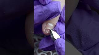 No other way with Onycholysis😭 #nails #nailproblems #nailtutorial #manicure #nailtips No other way with Onycholysis😭 #nails #nailproblems #nailtutorial #manicure #nailtips