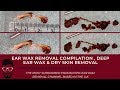EAR WAX REMOVAL COMPILATION - DEEP EAR WAX & DRY SKIN REMOVAL - EP 281