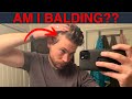 How to spot early signs of balding catch androgenic alopecia fast
