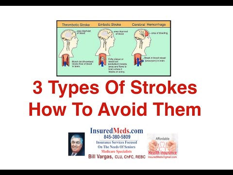 3 Types Of Strokes And How To Avoid Them