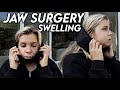 recovering from jaw surgery: what it's really like (post op day 1-4)