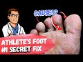 🦶BEST 9 Athlete&#39;s Foot Fungus Remedies [&amp; the #1 Big Mistake]🦶