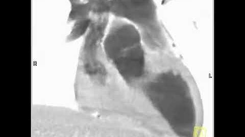 4D Imaging of the Aortic Valve 3D and 4D rendering of the heart (3 of 3)