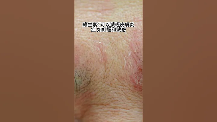 番茄- 減少皮膚炎症 - 天天要聞