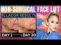 The worlds first scarless facelift skin liftingtightening ellacor update