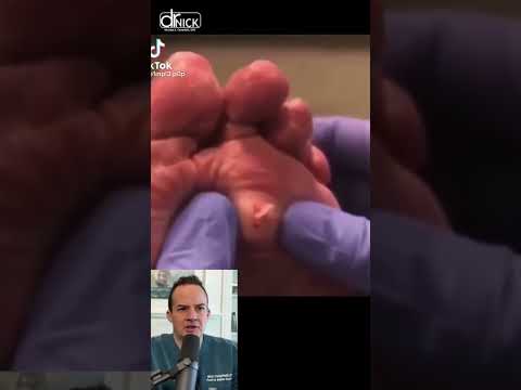 رد فعل الطبيب كيس متفجر في أسفل القدم شورت رد فعل