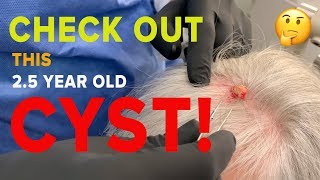 SCALP CYST POP (FULL PROCEDURE!)