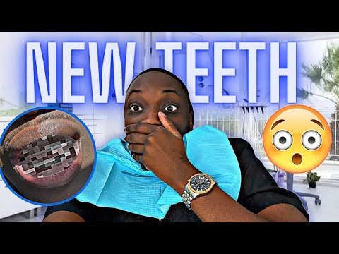 I GOT NEW TEETH ! * Wont believe my friends Reactions * 🤯