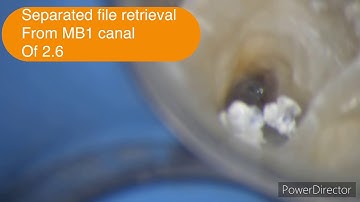 Broken file retrieval By ultrasonic device ( ultra x ) from Eighteeth