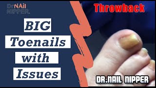 How to Treat a Big Toenail? What is onycholysis?  Toenails with Issues