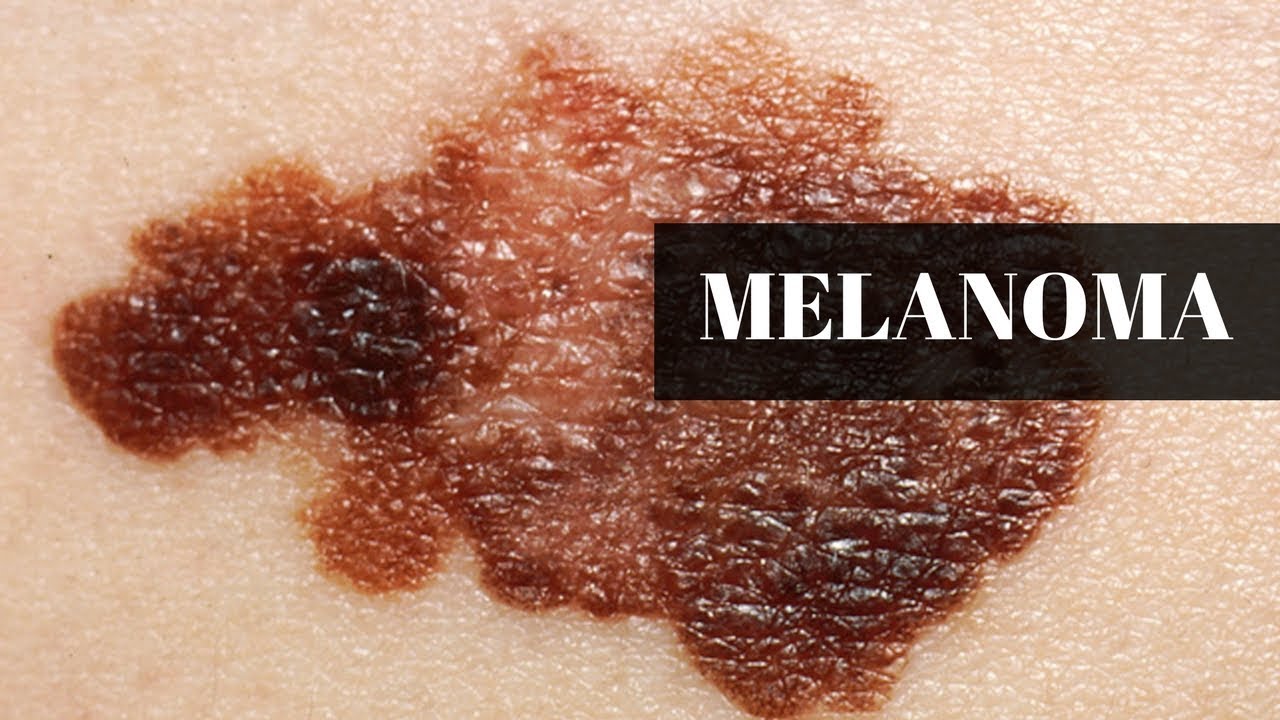 What Are The Prognosis And Survival Rates For Melanoma By Stage YouTube what-are-the-prognosis-and-survival-rates-for-melanoma-by-stage-youtube
