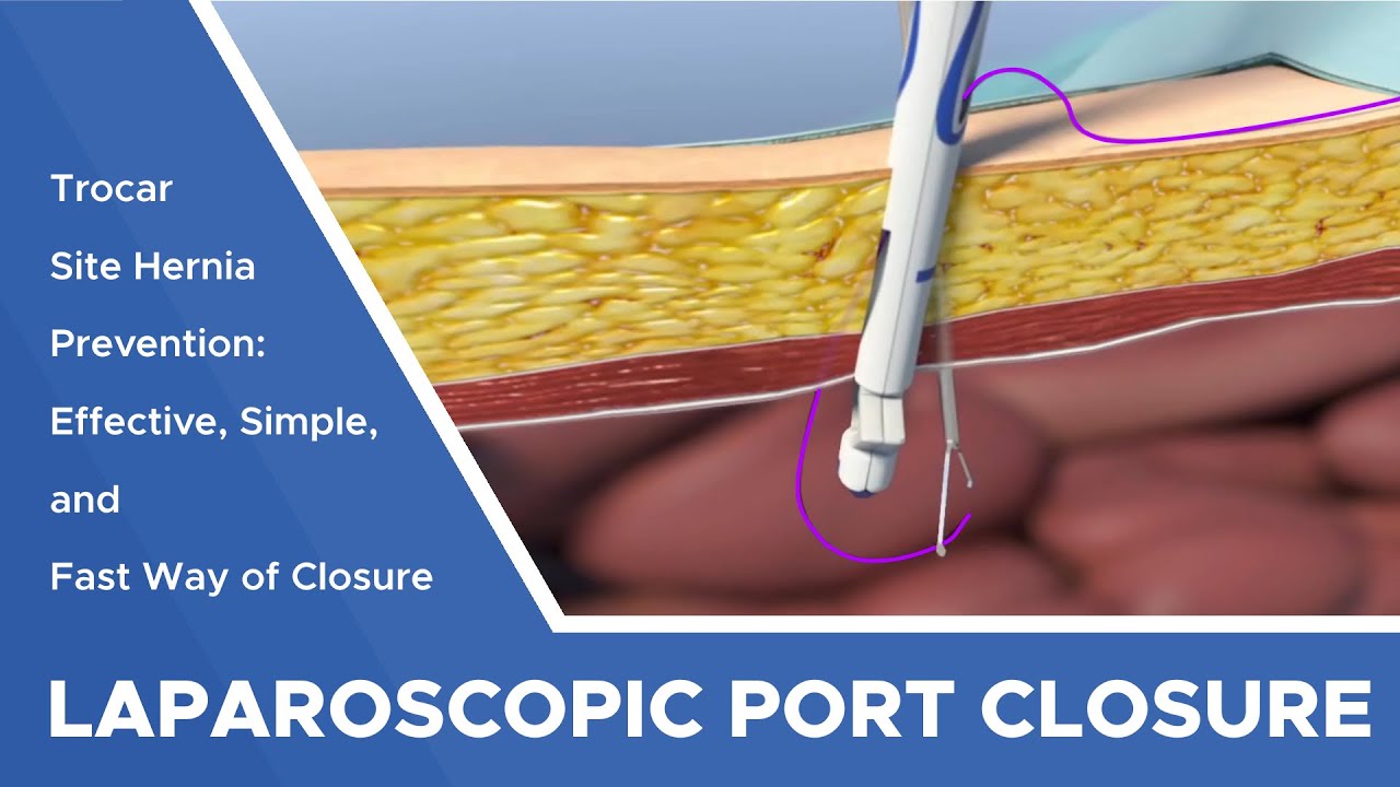 Effective Simple And Fast Way Of Laparoscopic Port Closure For Trocar effective-simple-and-fast-way-of-laparoscopic-port-closure-for-trocar